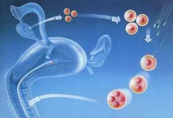 Tratamento - Fertilização In Vitro - FIV